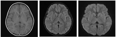 Case report: Fatal cerebral herniation caused by hypoglycemic due to mistaking glibenclamide in children